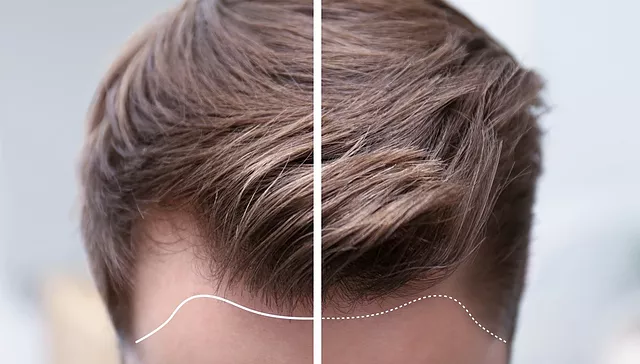 beste haartransplantatie istanbul beste haartransplantatie istanbul
