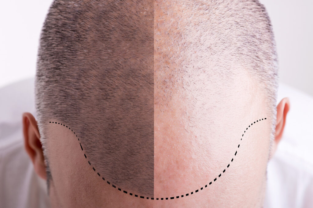 haartransplantatie turkije